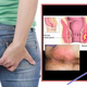 Illustration for article titled Apakah Obat Fistula Ani